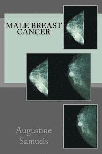 Male Breast Cancer 1