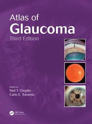 Atlas of Glaucoma 1