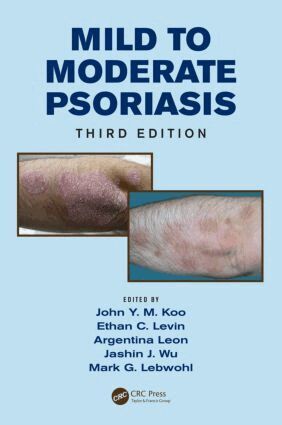 John Koo, Ethan Levin, Argentina Leon, Jashin Wu, Mark Lebwohl - Mild to Moderate Psoriasis, Inbunden