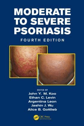 John Koo, Jashin Wu, Alice Gottlieb, Ethan Levin, Argentina Leon - Moderate to Severe Psoriasis, Inbunden