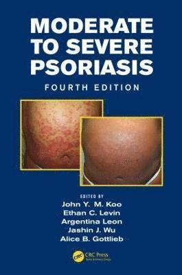 bokomslag Moderate to Severe Psoriasis