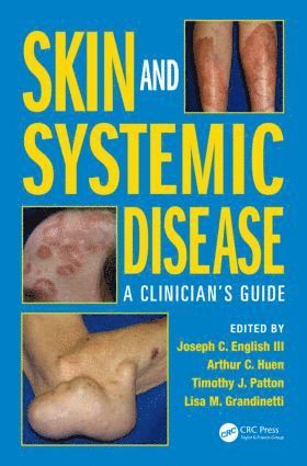 Joseph C. English III, Arthur C. Huen, Timothy J. Patton, Lisa M. Grandinetti, USA) English III, Joseph C. (Professor of Dermatology, University of Pittsburgh Medical Center, PA, Joseph C English III, Timothy J Patton - Skin and Systemic Disease, Inbunden