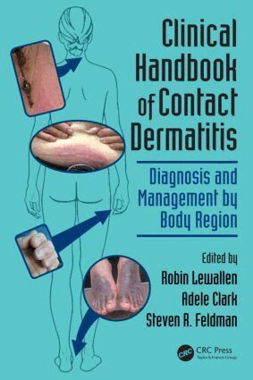 Robin Lewallen, Adele Clark, Steven R. Feldman - Clinical Handbook of Contact Dermatitis, Häftad