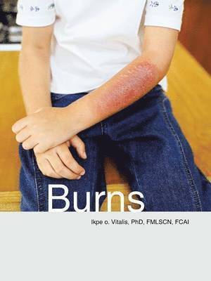 Burns 1