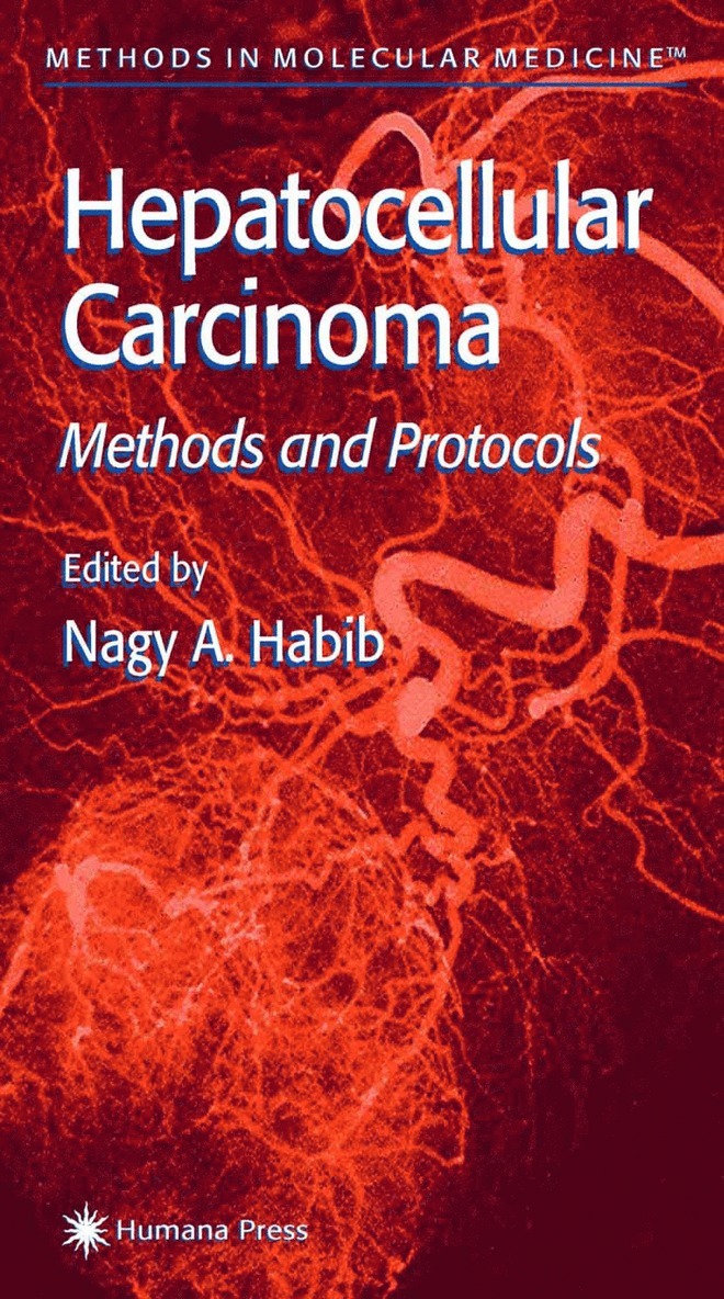 Hepatocellular Carcinoma 1