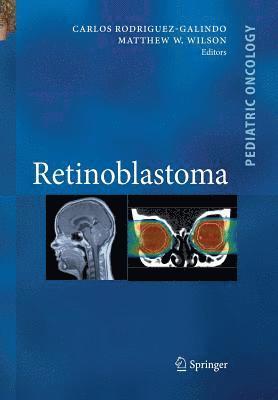 bokomslag Retinoblastoma