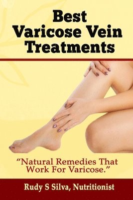 Best Varicose Vein Treatments: Natural Remedies That Work for Varicose 1