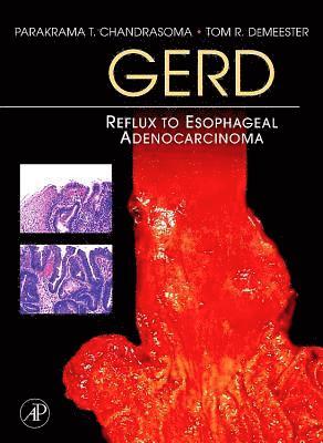 bokomslag Gerd: Reflux to Esophageal Adenocarcinoma