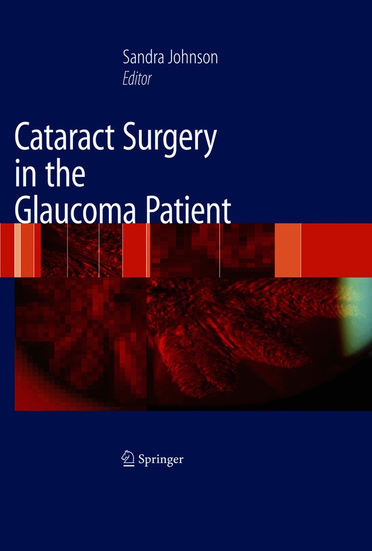 Sandra M. Johnson - Cataract Surgery in the Glaucoma Patient, Häftad