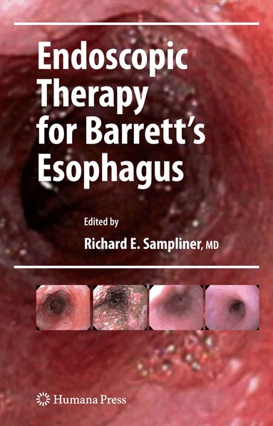 Richard E. Sampliner - Endoscopic Therapy for Barrett's Esophagus, Häftad