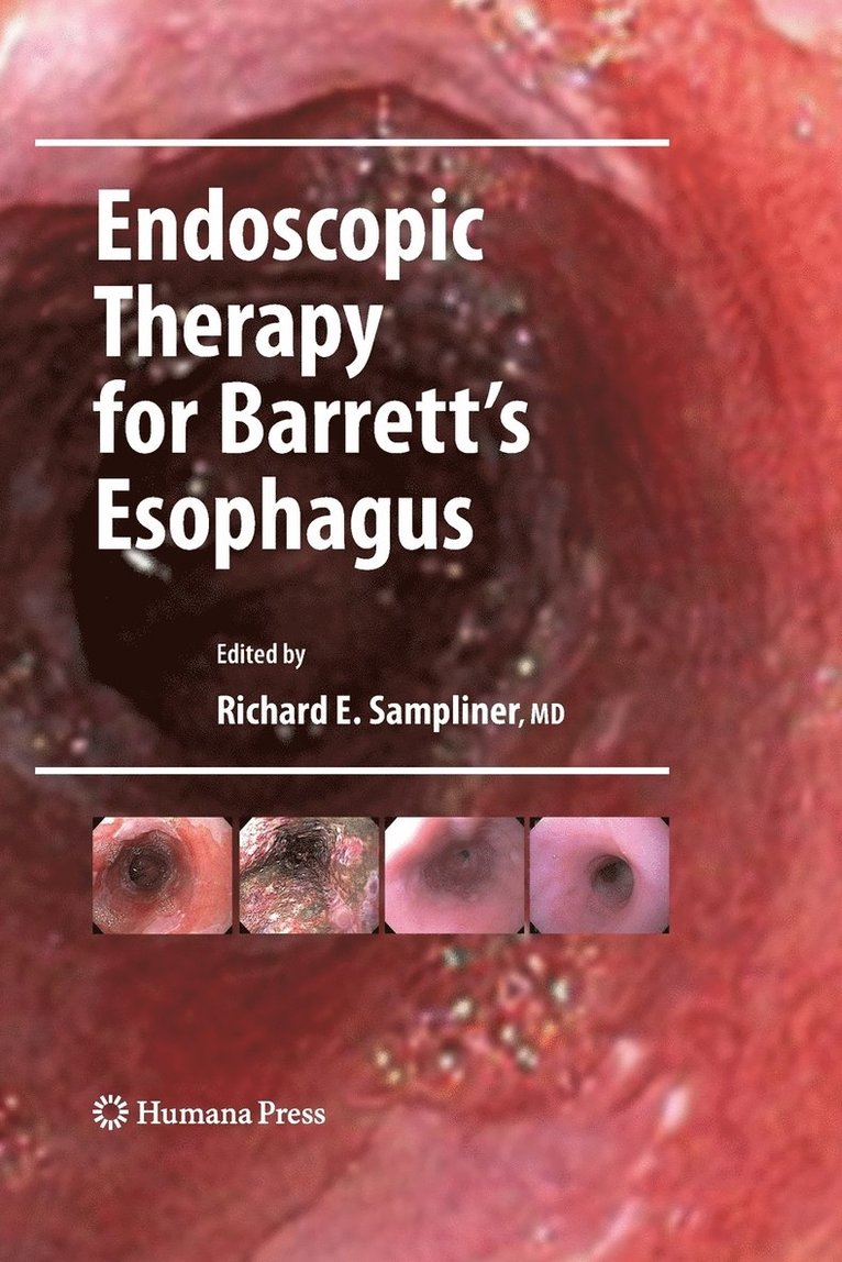 Endoscopic Therapy for Barrett's Esophagus 1