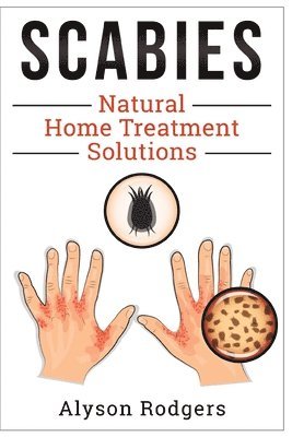 Scabies Natural Home Treatment Solution 1