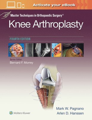 Master Techniques in Orthopedic Surgery: Knee Arthroplasty 1