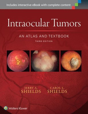 Intraocular Tumors: An Atlas and Textbook 1