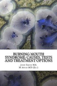 Burning Mouth Syndrome: Causes, Tests and Treatment Options 1