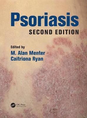 Psoriasis 1