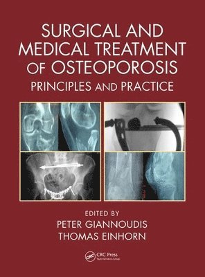 Surgical and Medical Treatment of Osteoporosis 1