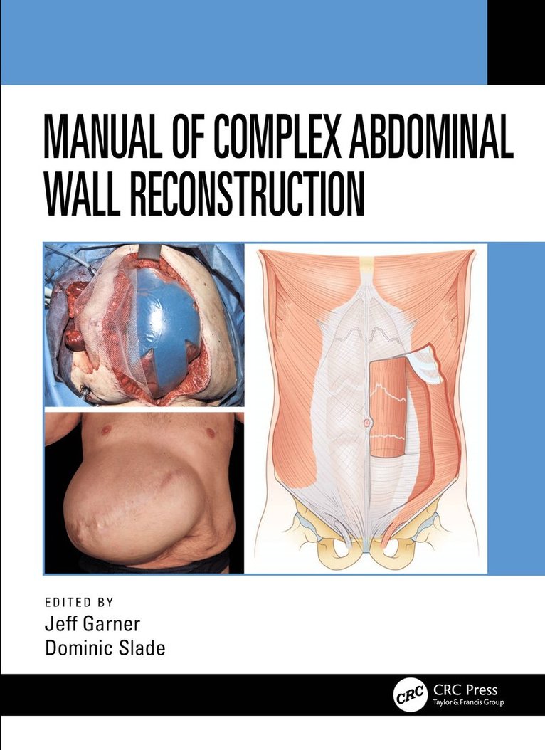Jeff Garner, Dominic Slade, South Yorkshire.) Garner, Jeff (Rotherham NHS Foundation Trust, UK) Slade, Dominic (Salford Royal NHS Foundation Trust - Manual of Complex Abdominal Wall Reconstruction, Häftad