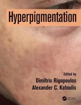 Hyperpigmentation 1