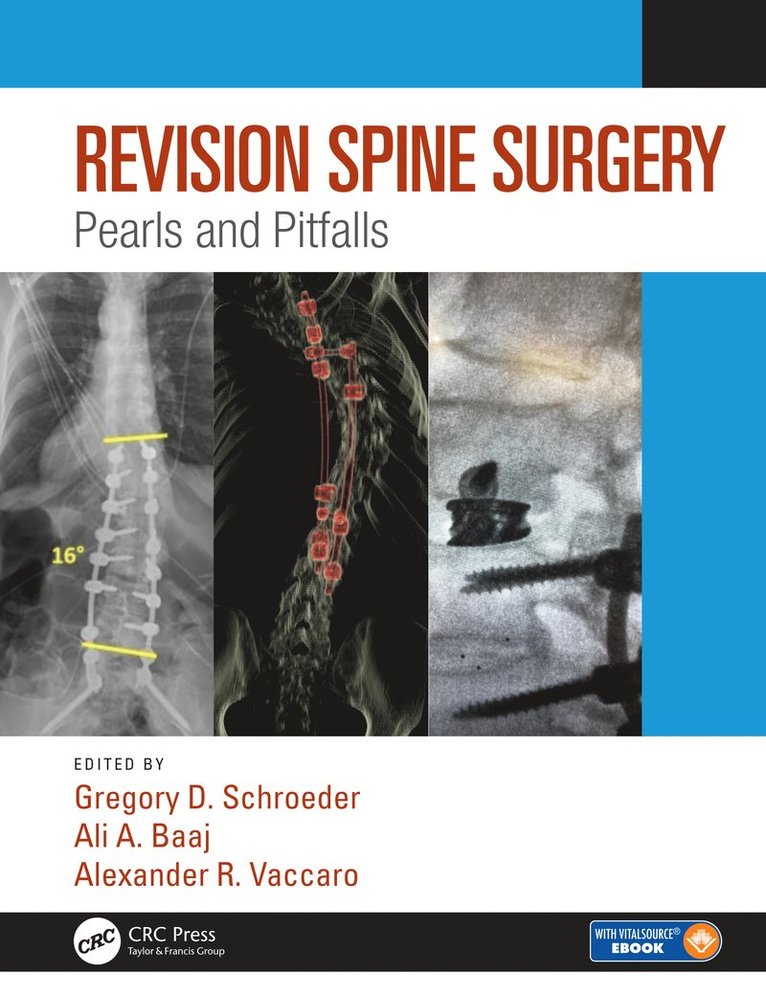 Gregory D. Schroeder, Ali A. Baaj, Alexander R. Vaccaro, USA) Schroeder, Gregory D. (Thomas Jefferson University, Philadelphia, Pennsylvania, USA) Baaj, Ali A. (Weill Cornell Brain and Spine Center, New York, NY, USA) Vaccaro, Alexander R. (Thomas Jefferson University, Philadelphia, Pennsylvania - Revision Spine Surgery, Inbunden