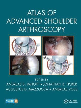 Andreas B. Imhoff, Jonathan B. Ticker, Augustus D. Mazzocca, Andreas Voss, Germany) Imhoff, Andreas B. (Technical University of Munich, USA) Ticker, Jonathan B. (Columbia University, College of Physicians and Surgeons, New York, New York, USA, and Orlin & Cohen Orthopaedic Group, Merrick, New York, USA) Mazzocca, Augustus D. (UConn Health, Department of Orthopaedic Surgery, Farmington, Connecticut, Germany) Voss, Andreas (Technical University of Munich - Atlas of Advanced Shoulder Arthroscopy, Inbunden