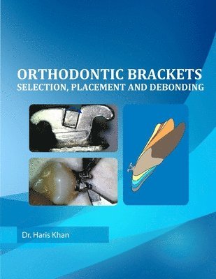 Orthodontic Brackets: Selection, Placement and Debonding 1