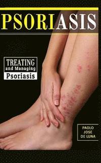 bokomslag Psoriasis: Treating and Managing Psoriasis