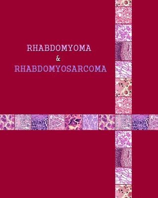 Rhabdomyoma & Rhabdomyosarcoma 1