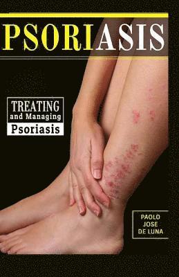 bokomslag Psoriasis: Treating and Managing Psoriasis