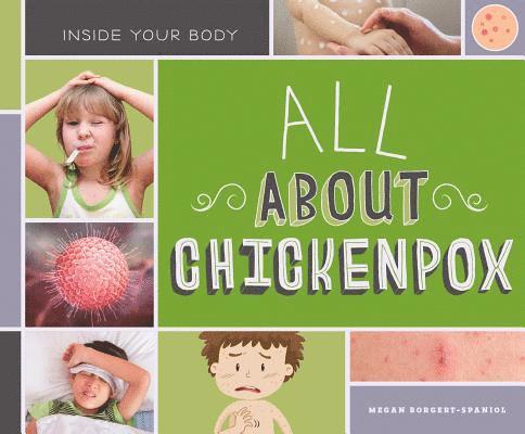 All about Chickenpox 1