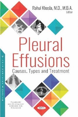 bokomslag Pleural Effusions