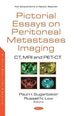 Pictorial Essays on Peritoneal Metastases Imaging 1