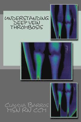 Understanding Deep Vein Thrombosis 1