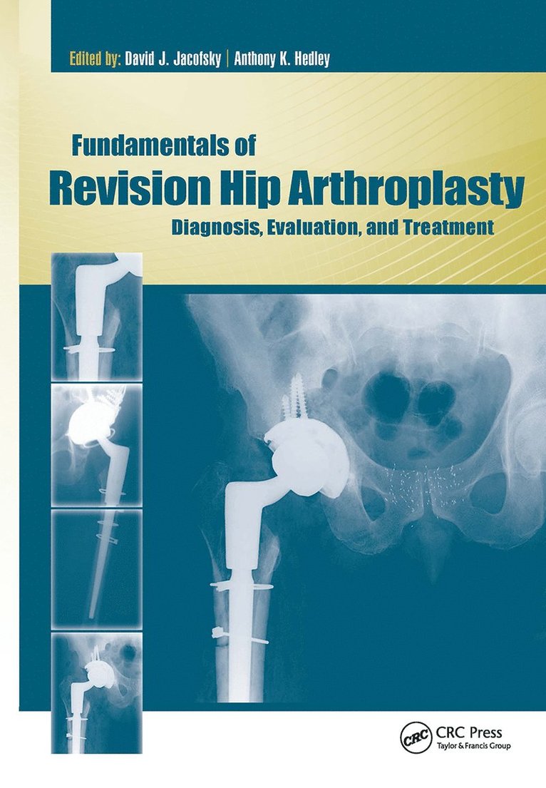David Jacofsky, Anthony Hedley - Fundamentals of Revision Hip Arthroplasty, Inbunden