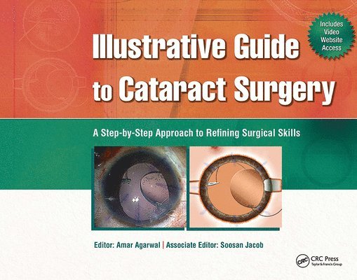 Illustrative Guide to Cataract Surgery 1