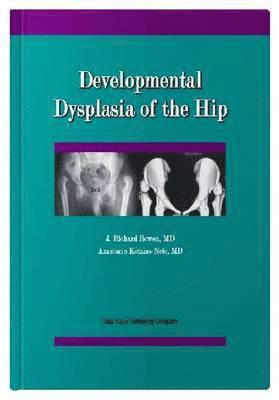 Developmental Dysplasia of the Hip