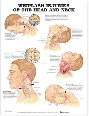 bokomslag Whiplash Injuries Of Head & Neck Chart