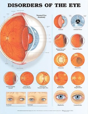 Disorders of the Eye Anatomical Chart 1