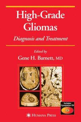 High-Grade Gliomas 1