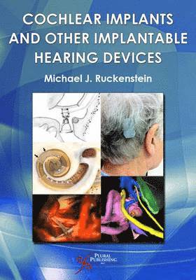 bokomslag Cochlear Implants and Other Implantable Hearing Devices