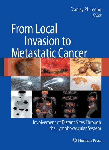 Stanley P. L. Leong - From Local Invasion to Metastatic Cancer, Inbunden