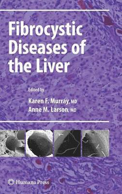Karen F. Murray, Anne M. Larson - Fibrocystic Diseases of the Liver, Inbunden