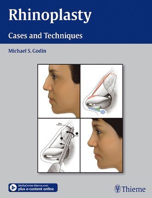 Michael S. Godin, Michael S Godin - Rhinoplasty, Inbunden