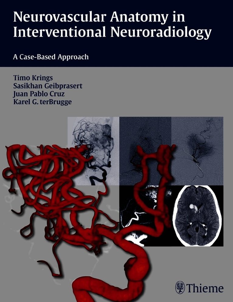 Neurovascular Anatomy in Interventional Neuroradiology