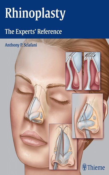 Anthony P. Sclafani - Rhinoplasty, Inbunden