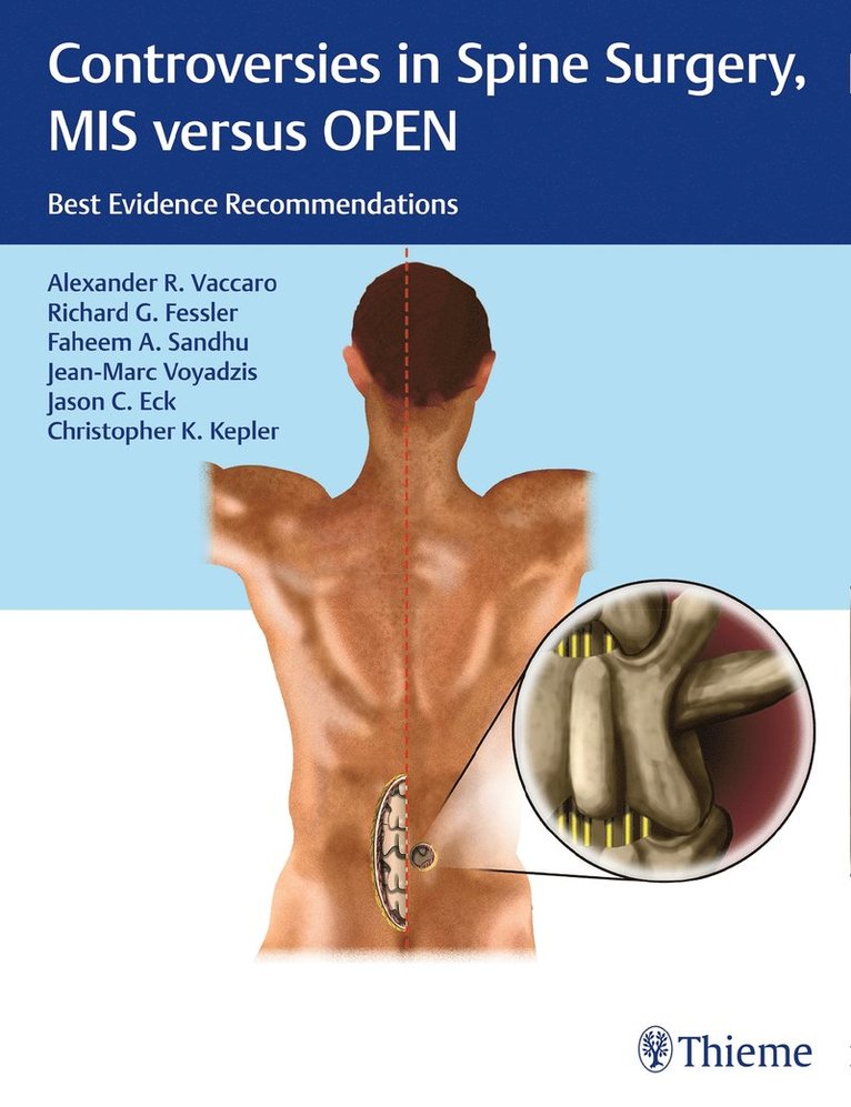 Alexander R. Vaccaro, Richard Glenn Fessler, Faheem A. Sandhu, Jean-Marc Voyadzis, Jason C. Eck, Christopher K. Kepler, PhD Fessler, Richard Glenn, MD, Alexander R Vaccaro, Faheem A Sandhu, Jason C Eck, Christopher K Kepler - Controversies in Spine Surgery, MIS Versus OPEN, Inbunden