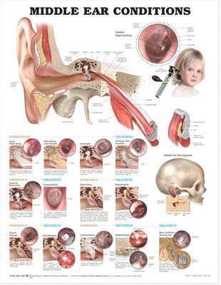 Middle Ear Conditions Anatomical Chart 1