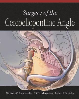 Surgery of the Cerebellopontine Angle