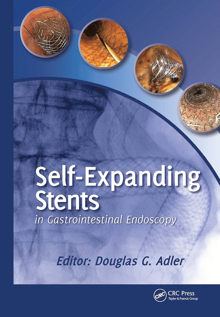 Self-Expanding Stents in Gastrointestinal Endoscopy 1