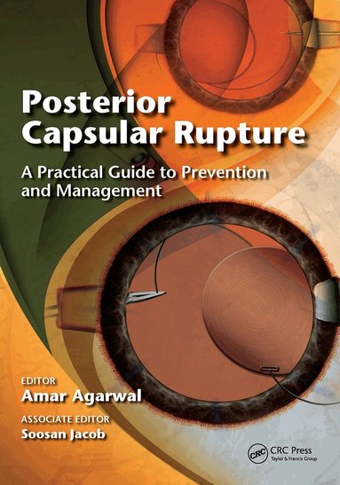 Amar Agarwal - Posterior Capsular Rupture, Häftad